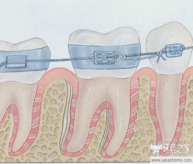 牙齿矫正拔牙的原理是什么