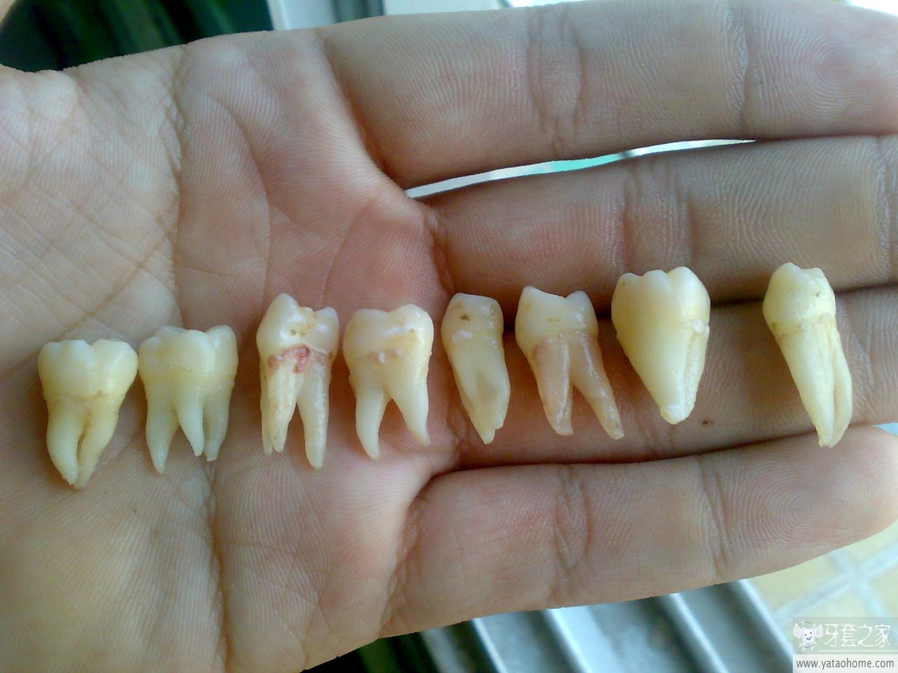 晒下我被拔的8颗牙-拔牙 智齿-牙套之家|牙齿矫正 最.